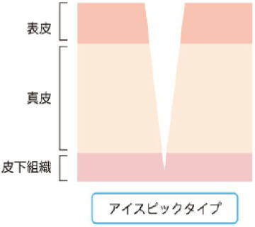 アイスピックタイプのへこみの図
