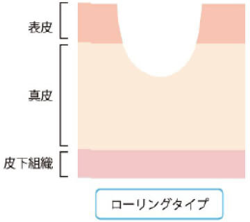 ローリングタイプのへこみの図