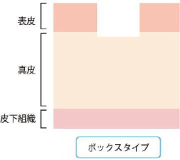 ボックスタイプのへこみの図